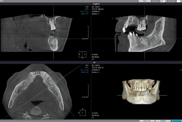 치료 계획에 사용한 3D CT 화면. 단면 세 방향과 입체 재구성 영상이 함께 표시되어 있다.