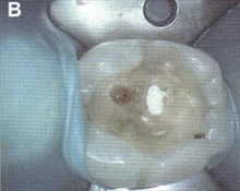 충치를 제거한 뒤 노출된 신경 부위에 흰색 MTA 재료를 덮은 구강 내 사진.